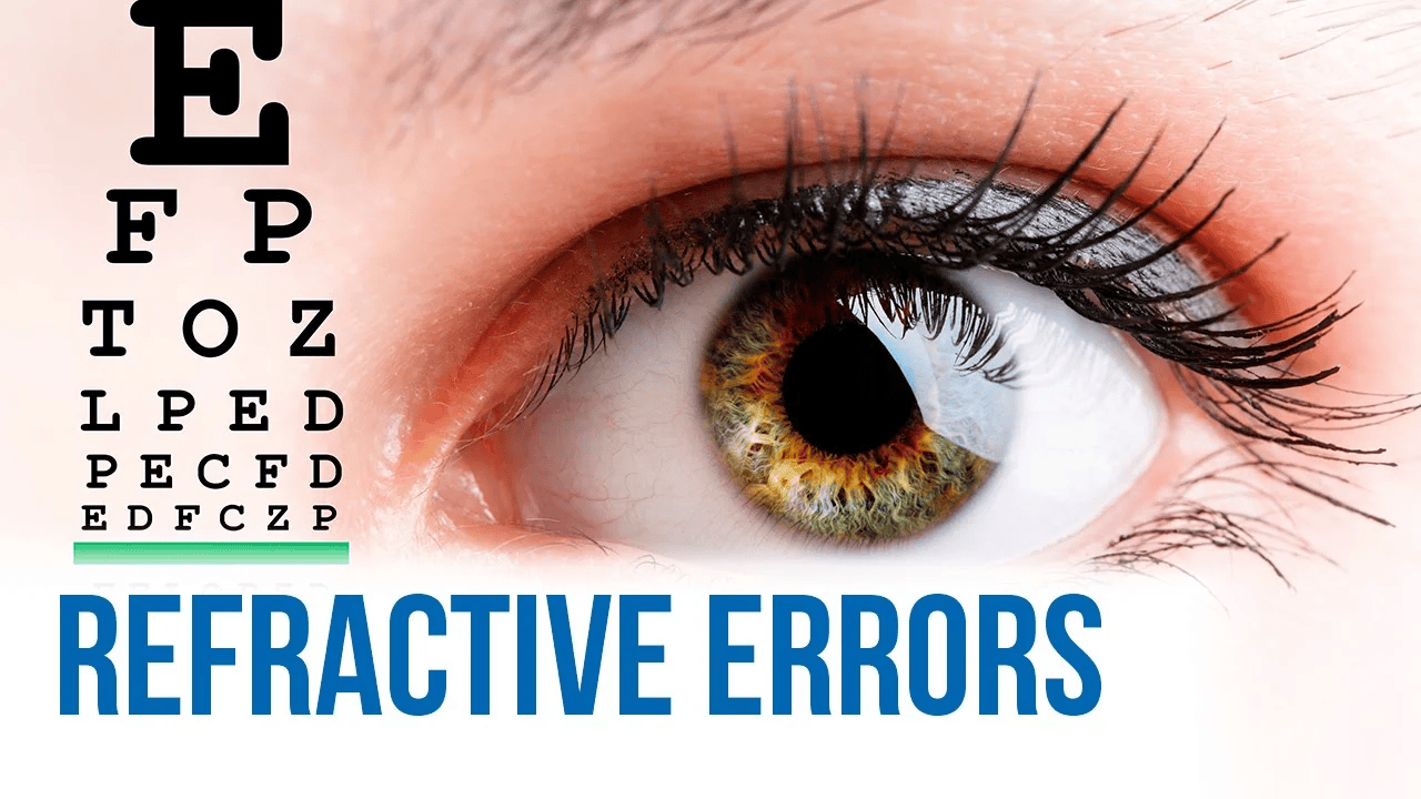 Refractive Errors